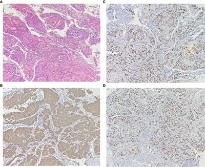 Partial cystectomy for bladder squamous cell carcinoma with a 10-year follow-up: a case report
